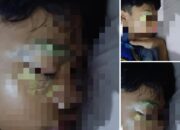 Anak SMP Alami Luka Serius di Mata Akibat Lemparan Batu, Keluarga Minta Pertanggungjawaban Pelaku